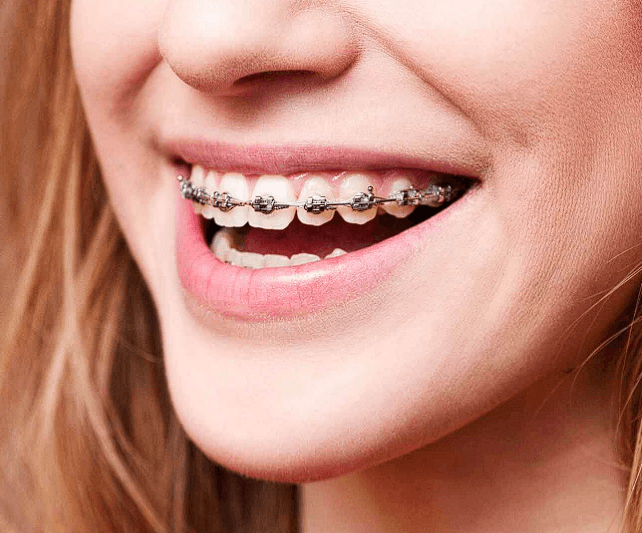 Aparelho Fixo Estético