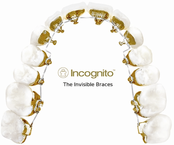 Aparelho lingual Incognito